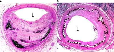 Medial artery calcification in peripheral artery disease